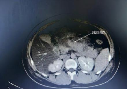 广东云浮一名14岁男性少年小杰（化名），午餐期间过量摄入6个鸡腿及多块红烧肉后，