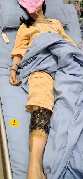 “命真大！”
一女子和丈夫去云南普洱旅游时，在酒店的床上不幸被银环蛇icon咬伤