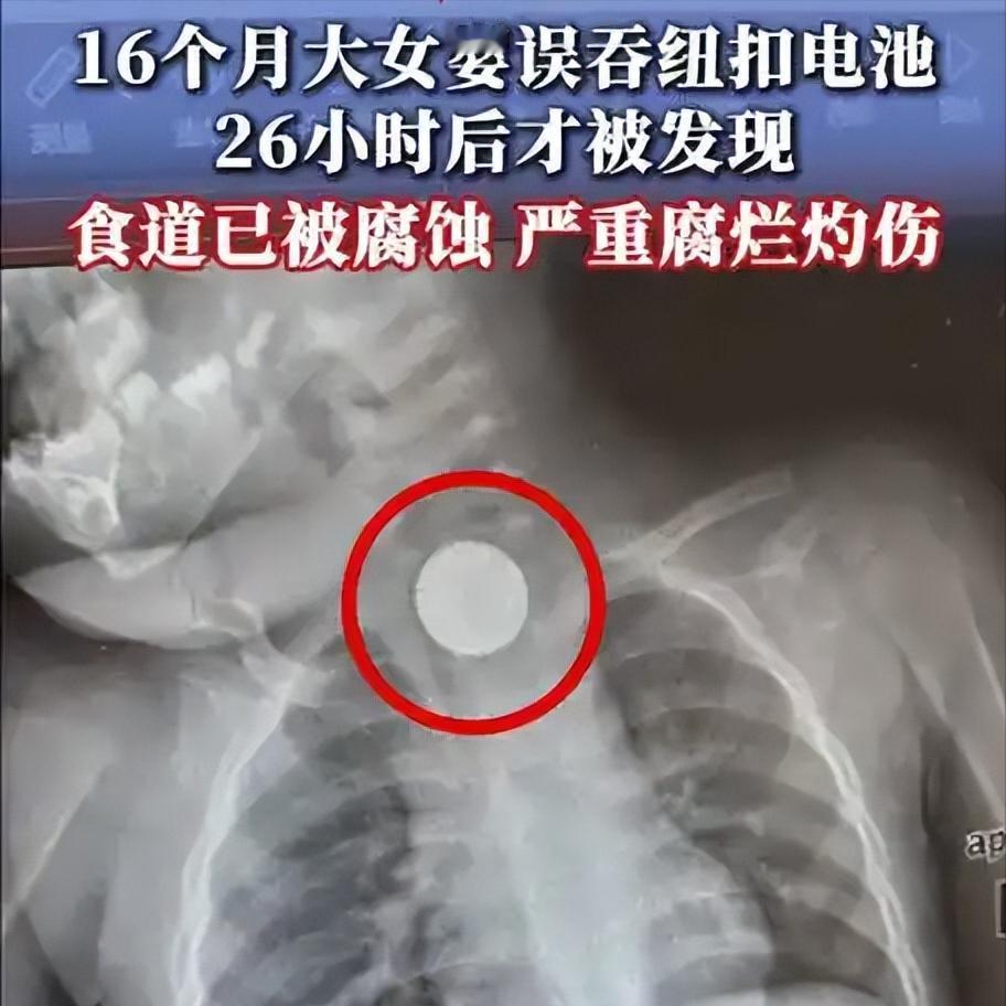 只差26小时，一颗小电池，毁掉宝宝整条食道
很多家长总觉得，孩子误吞异物是小概率