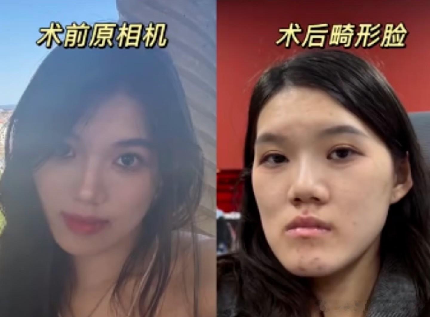 武汉24岁女孩小雨，有轻微的“地包天”，本可正畸改善，却被建议做正颌手术。结果手