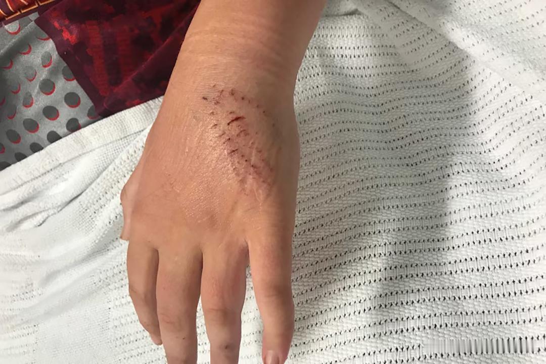 被蛇咬别“再等等”！印度男孩的悲剧该惊醒所有人

世卫组织说蛇咬伤在亚洲、非洲等