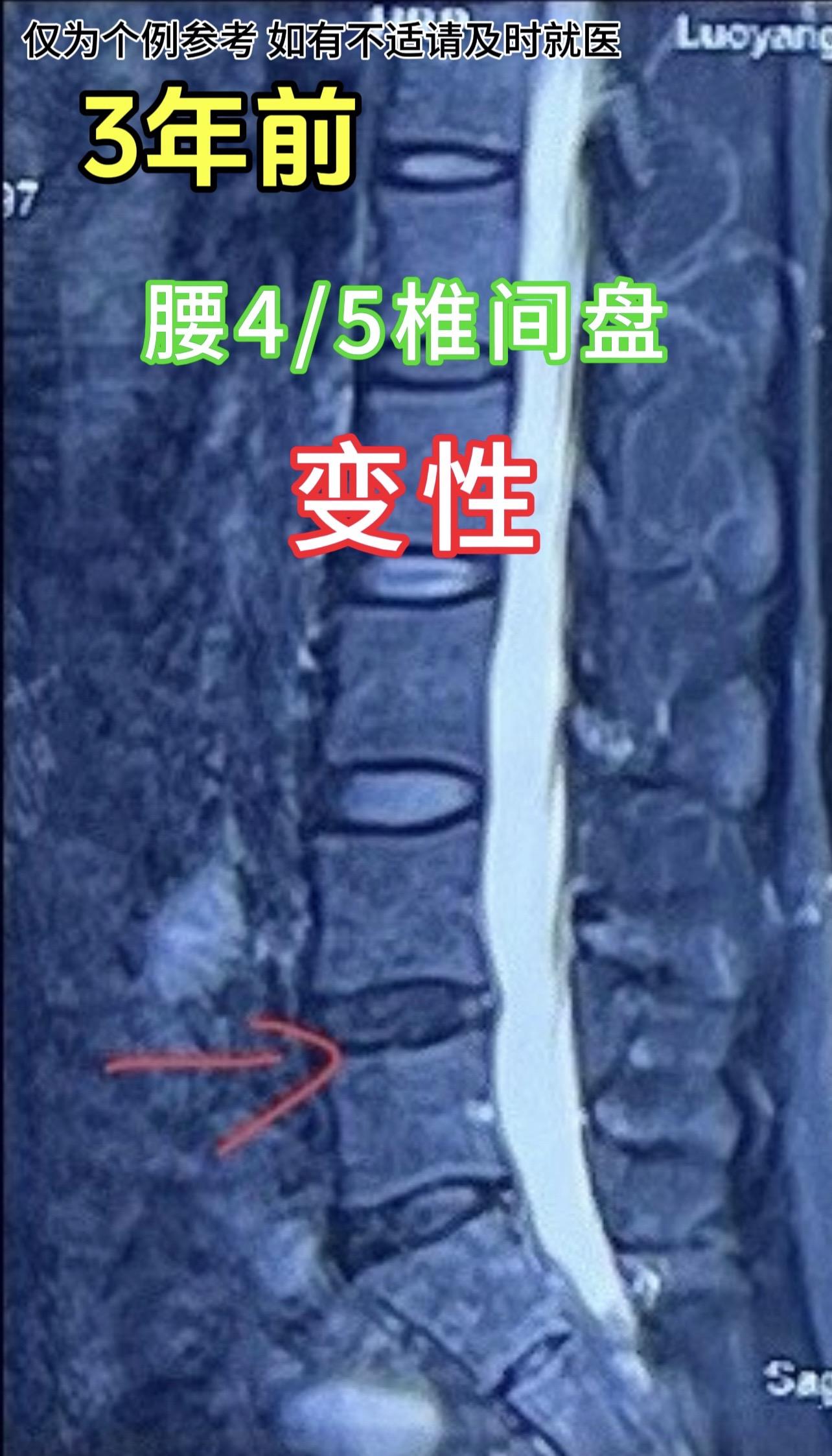 门诊碰到一个患者，40岁左右女性，久坐，腰4/5椎间盘由变性到突出的过程。
刚哥提醒：腰椎间盘，最怕久坐久站和弯腰。