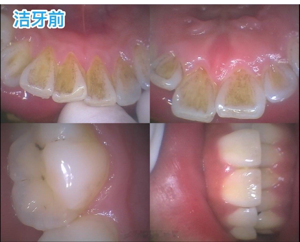 冷知识：北京洗牙已经被洗车还便宜了😂性价比太高了  ​​​