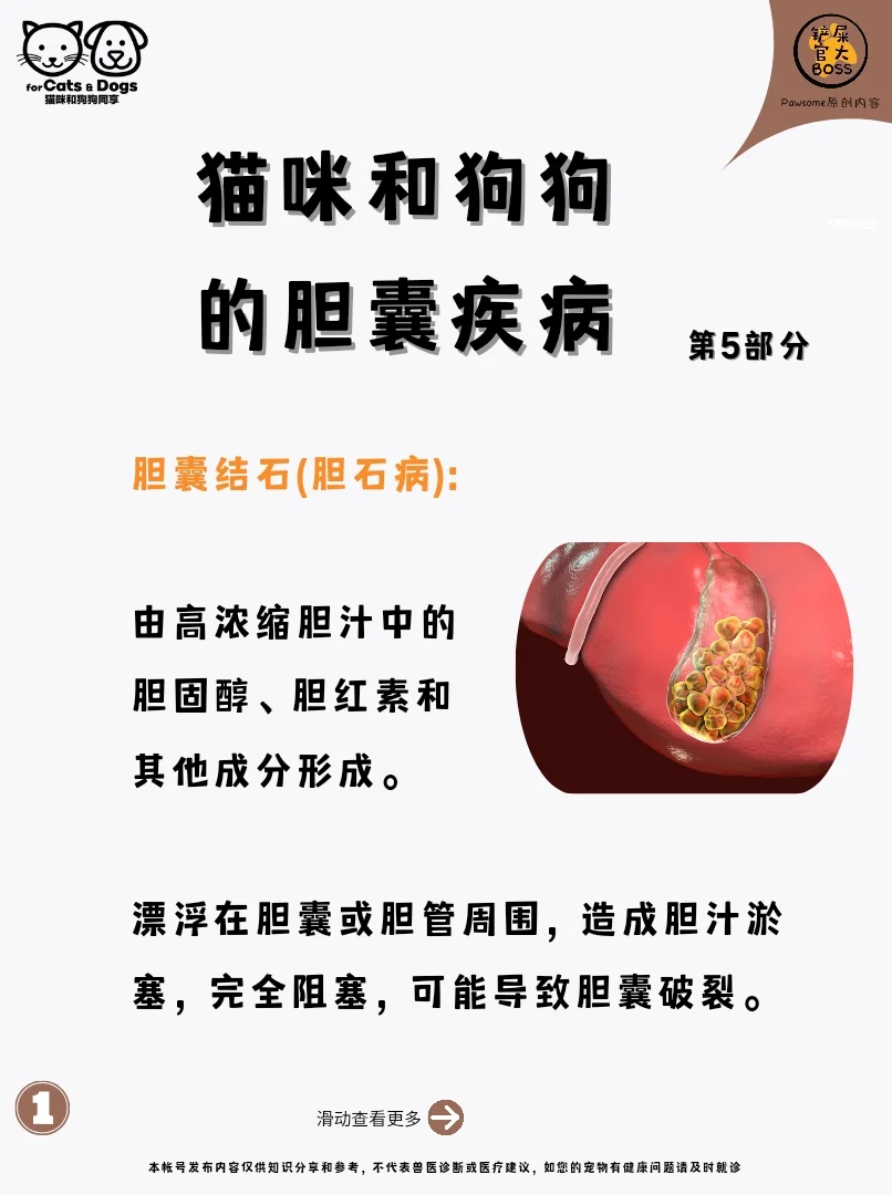 胆囊结石(胆石病)