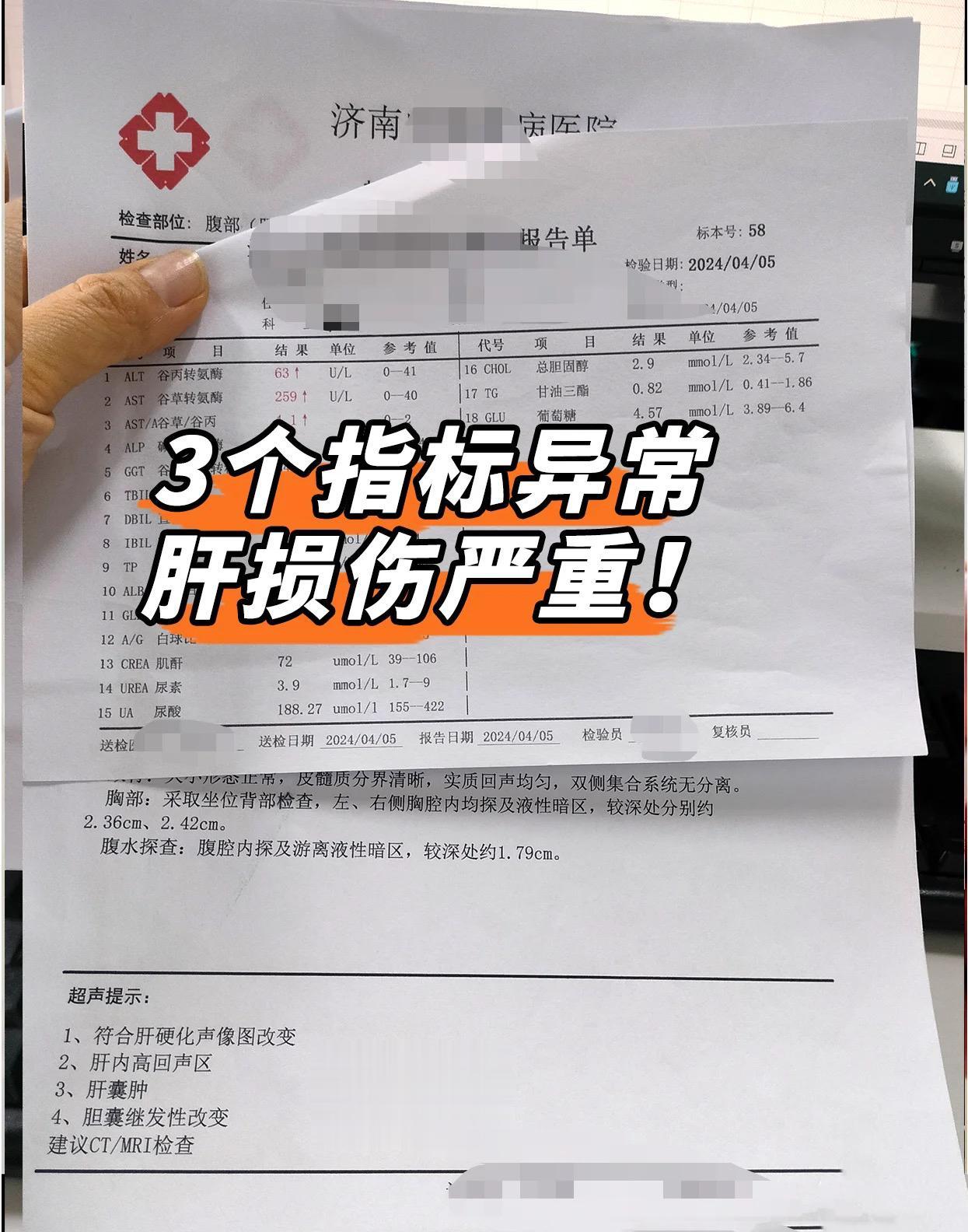 肝功能这3个指标异常，肝脏损伤严重！。第一谷丙转氨酶和谷草转氨酶，表示肝细胞受损程度，肝细胞受损后，转氨酶从细胞中被释放到血液中，尤其是谷草转氨酶的数值升高表示肝脏可能有严重的损伤。 
第二胆红素：包括直接胆红素和间接胆红素，胆道梗阻可以导致肝细胞受损，出现肝细胞性黄疸情况时，胆红素指标会升高，数值越高受损越严重，需要注意。 
第三蛋白：白蛋白和球蛋白，如果这2项数值降低表示肝脏合成蛋白能力有所下降，白蛋白低于35会有腹水的风险！出现以上任何一个都需要重视病情。及早诊治！