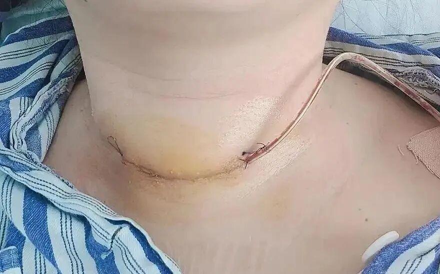 图1，传统手术切口缝合
图2,3颈侧切开切口，衣领遮挡。
图4,5甲状腺巨大囊肿