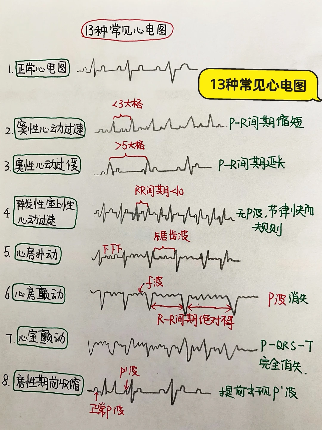 今日学习打卡——13种常见心电图