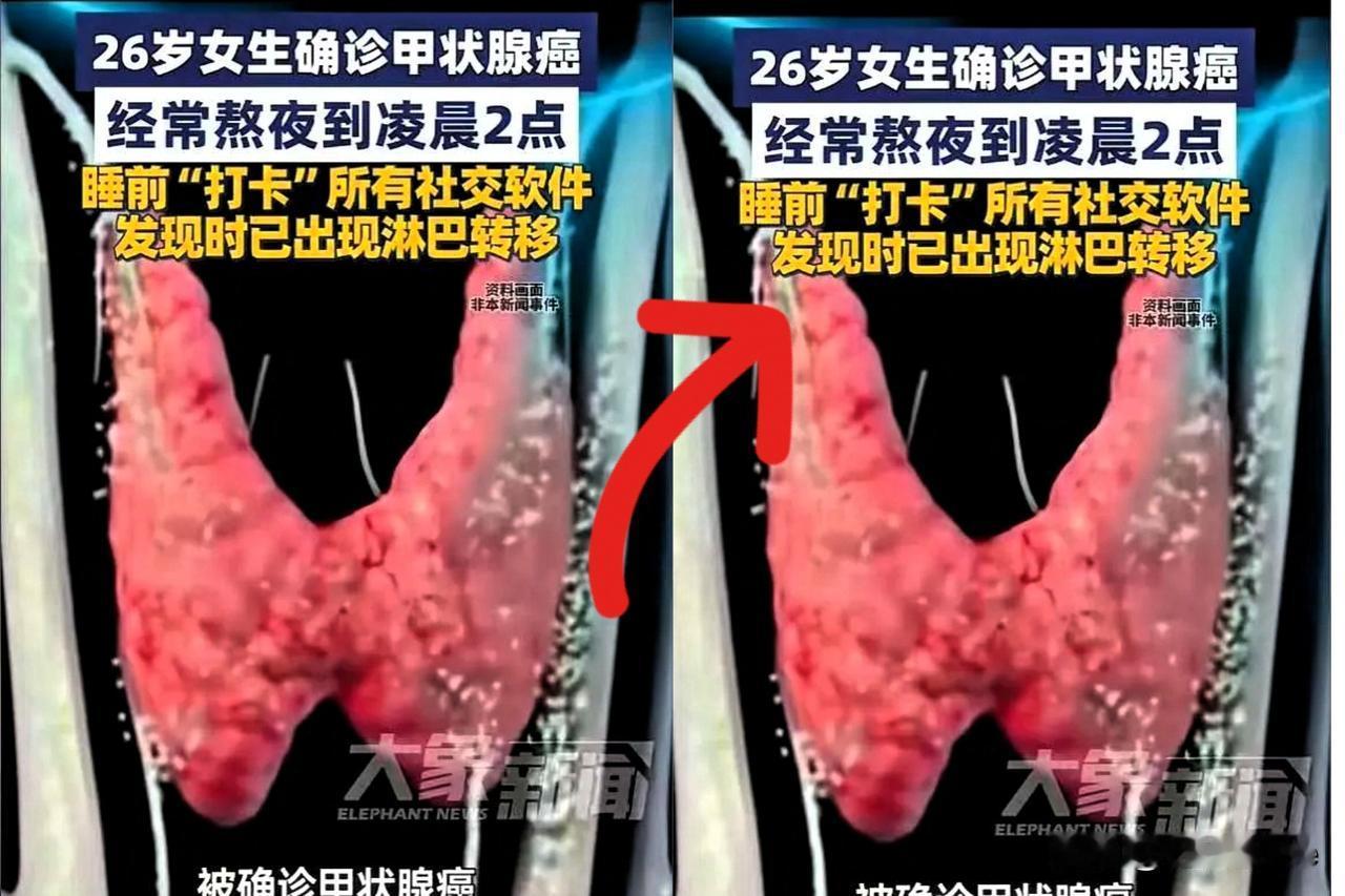 “熬夜一时爽，健康火葬场！”河南26岁女子长期熬夜刷手机至凌晨两点，最终确诊甲状