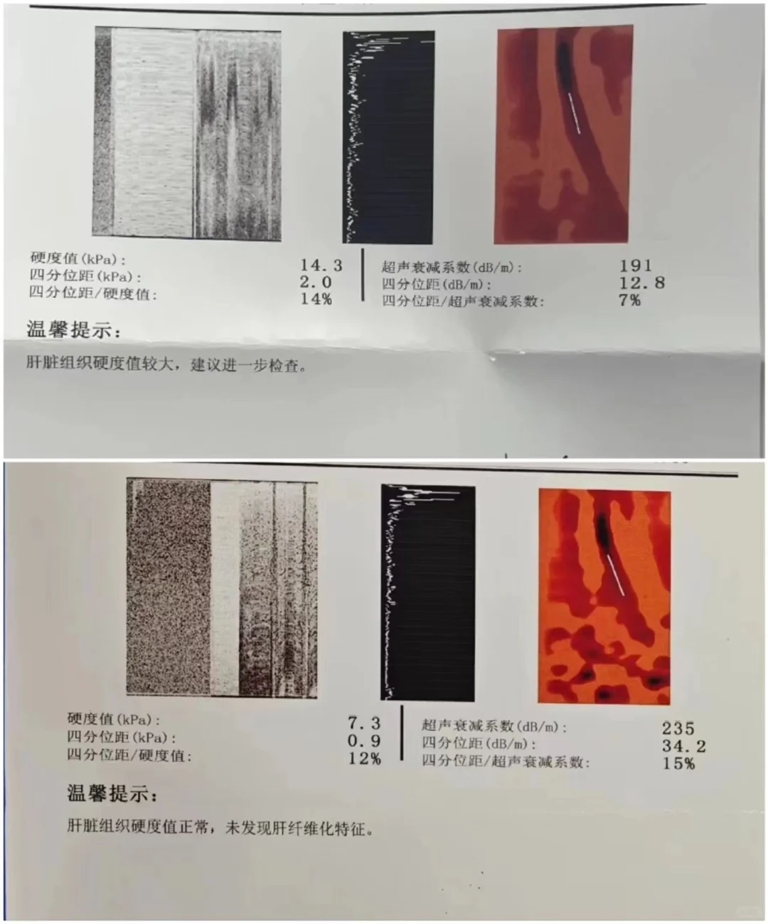 世上无难事只怕有心人，看看这位肝硬化患者如何逆转的，肝硬化多年并有乙肝...