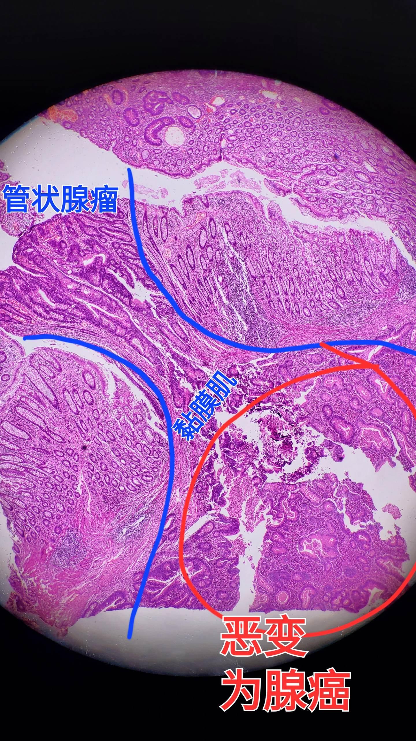 恶变为腺癌