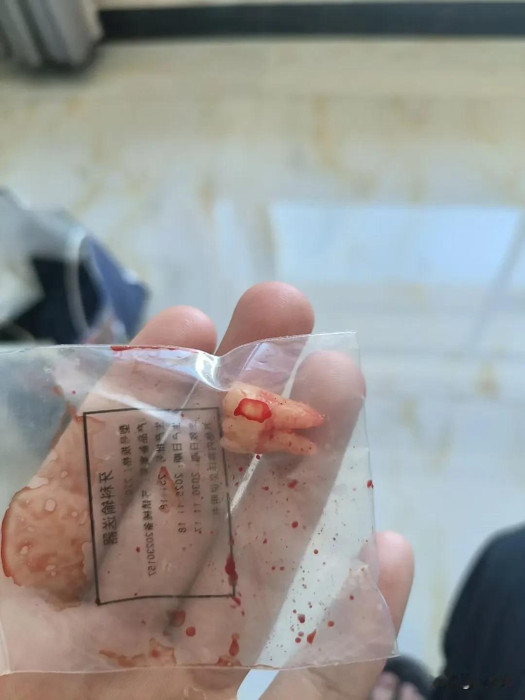 今日话题:智齿到底该不该拔？其实很多人可能跟我有一样的困扰，就是每年智齿都会发炎