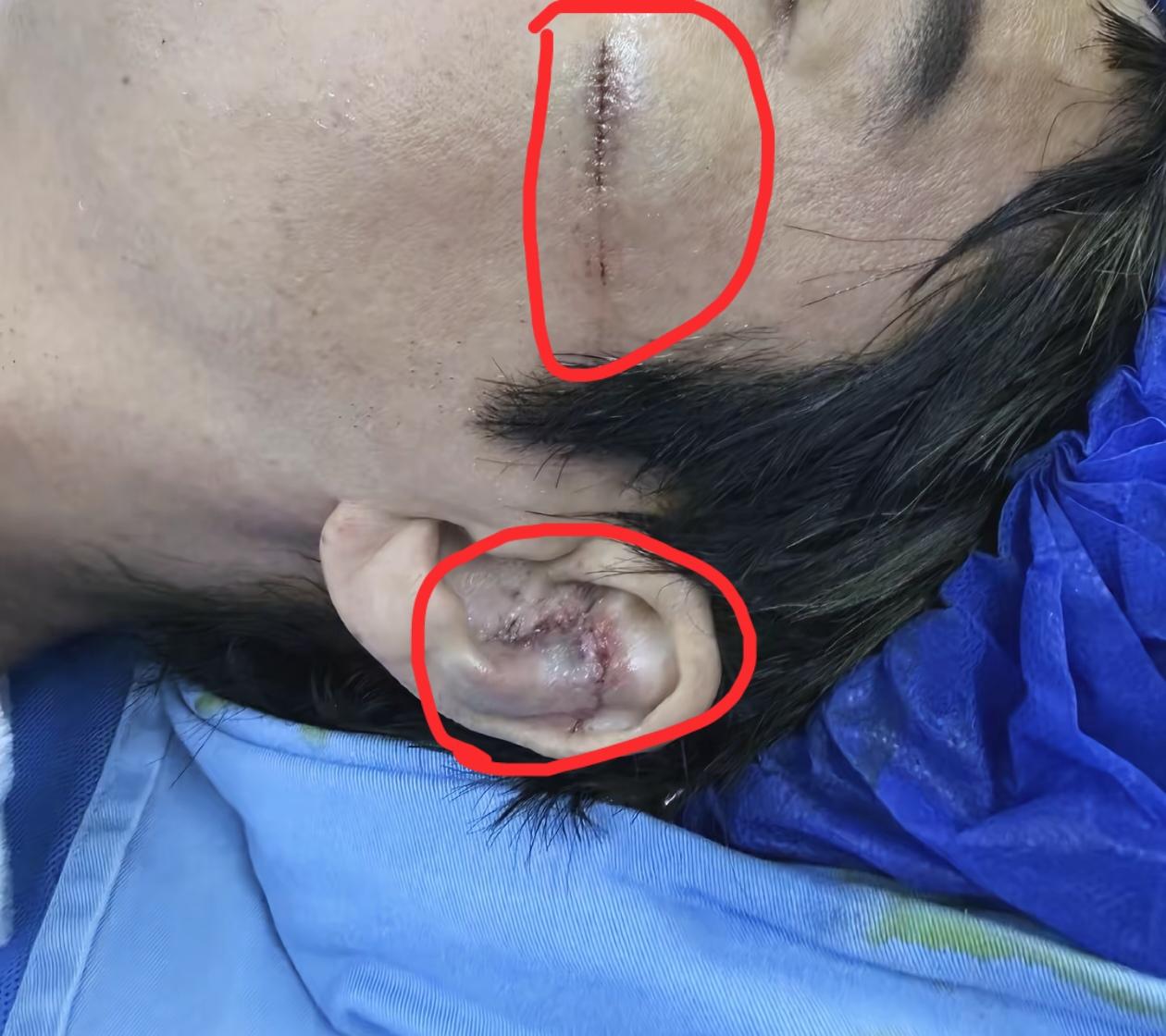 王力宏面部缝合画面曝光，脸部27针，耳朵12针，使用了美容针，缝合技术堪称完美，