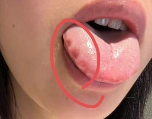 碰上齿痕印，虽不疼不痒，千万别拖着了
每天的疲乏，每天的失眠，每天的没精神🥱
