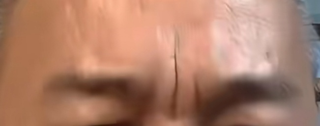 悬针纹要是长得越靠近印堂正中间，对人的影响就越厉害，这根纹路就像根针扎在那里一样
