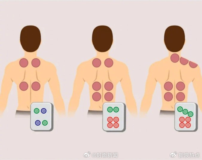 【#拔火罐吸出的瘀血并非排毒#，可能是皮肤受损的表现】#拔火罐减肥靠谱吗#？拔罐