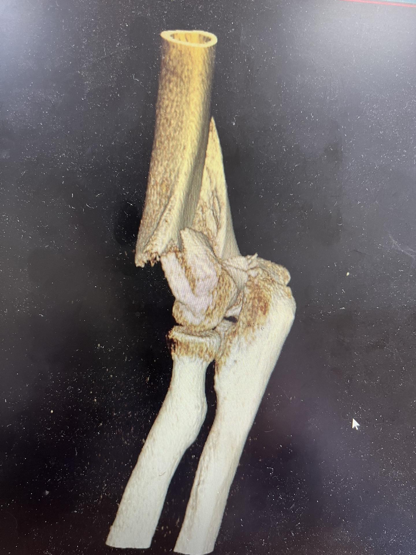 看起来很严重，实际上不轻，50岁男性，骑车摔倒，导致肱骨远端粉碎性骨折，保守治疗不佳，给予行骨折切开复位内固定术。
