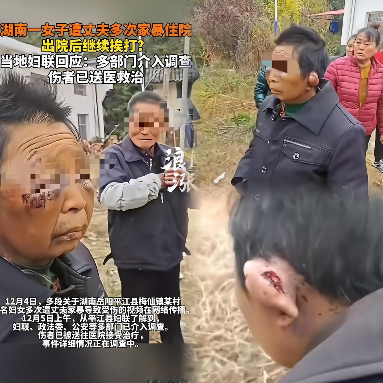 天呐！看到那视频里的画面，心都揪起来了！一位45岁大姐，脸肿得不成样，眼睛都睁不