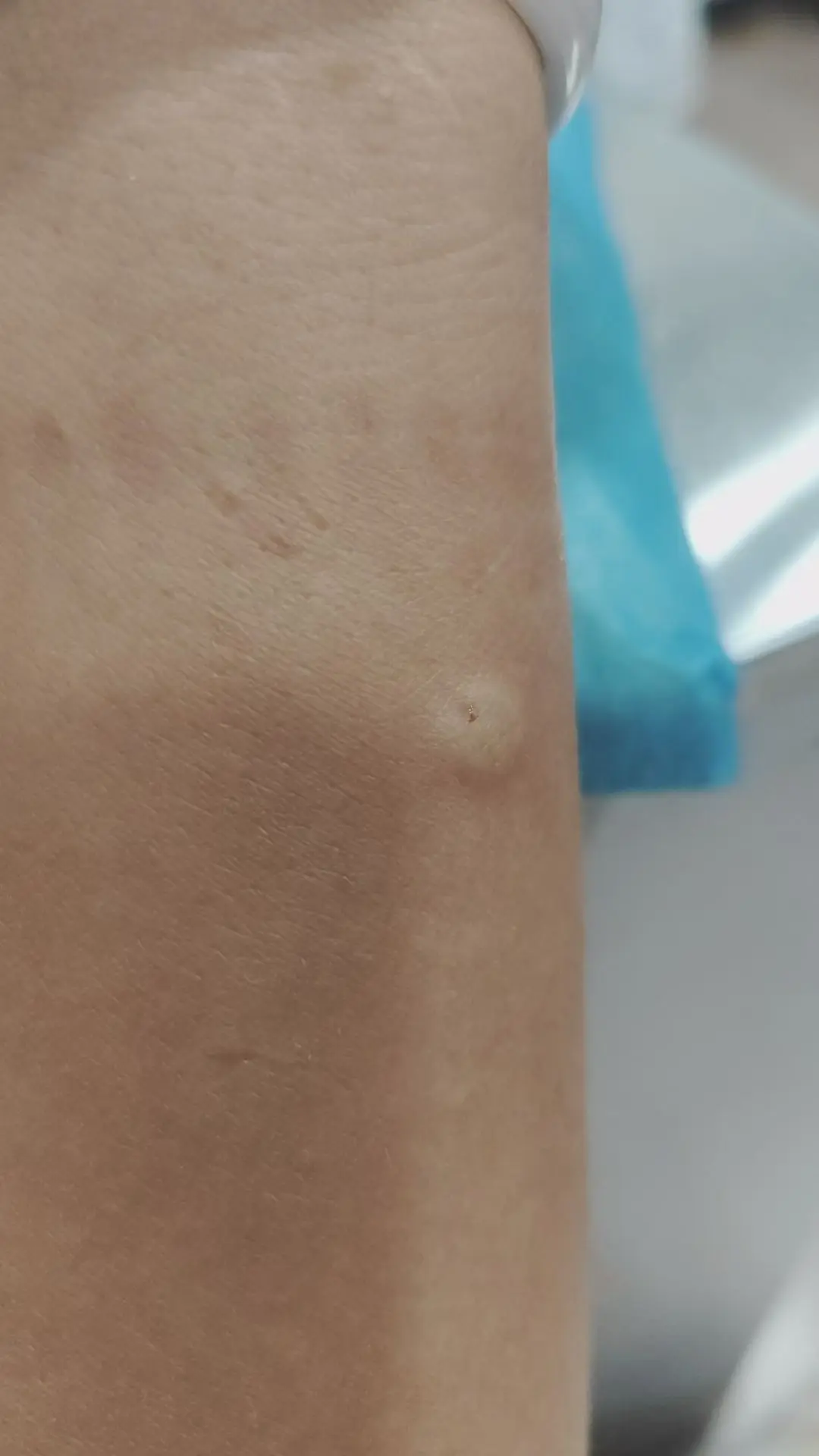 我不想做皮试，也不想打针，天天面对各种各样的针好怕。