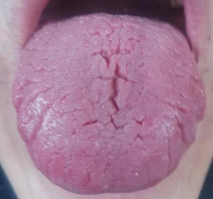 这种舌头你还敢去吃桂附地黄芄？再不收手，就算华佗在世也帮不了你！

就这样的舌头