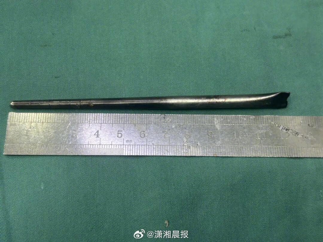 【#12cm金属筷子在男子咽部藏了8年#，#医生从男子咽部取出一根12cm筷子#