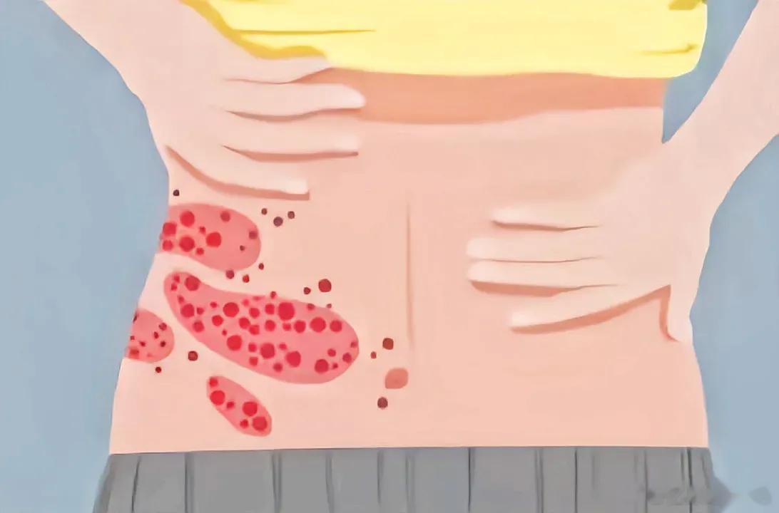 得了带状疱疹，这些东西可千万别吃！带状疱疹是一种病毒性疾病，它一般会在身体的某一