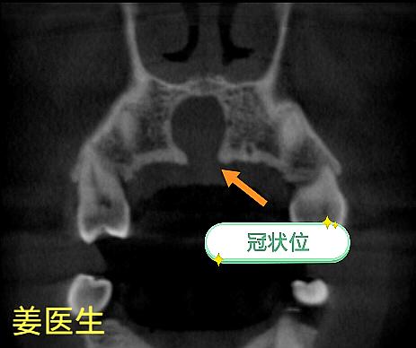 鼻腭囊肿。种植患者检查发现囊肿，局麻刮治、植骨，6个月后囊腔骨化。