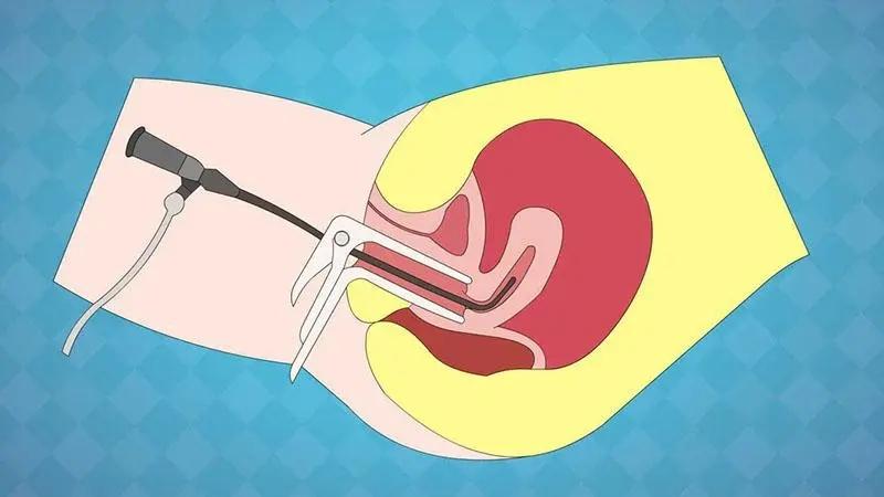 #健康真探社#【人流和刮宫，哪个对身体伤害更大？】现在许多女性在意外怀孕后选择进