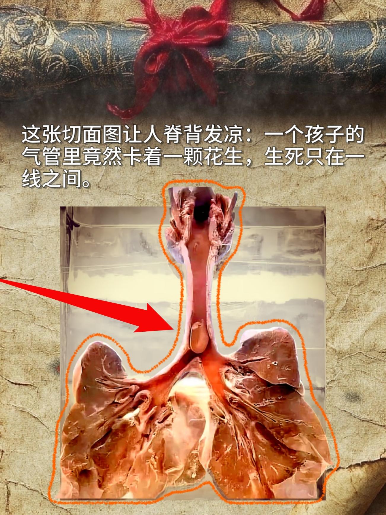 这张切面图让人脊背发凉：一个孩子的气管里竟然卡着一颗花生，生死只在一线之间。