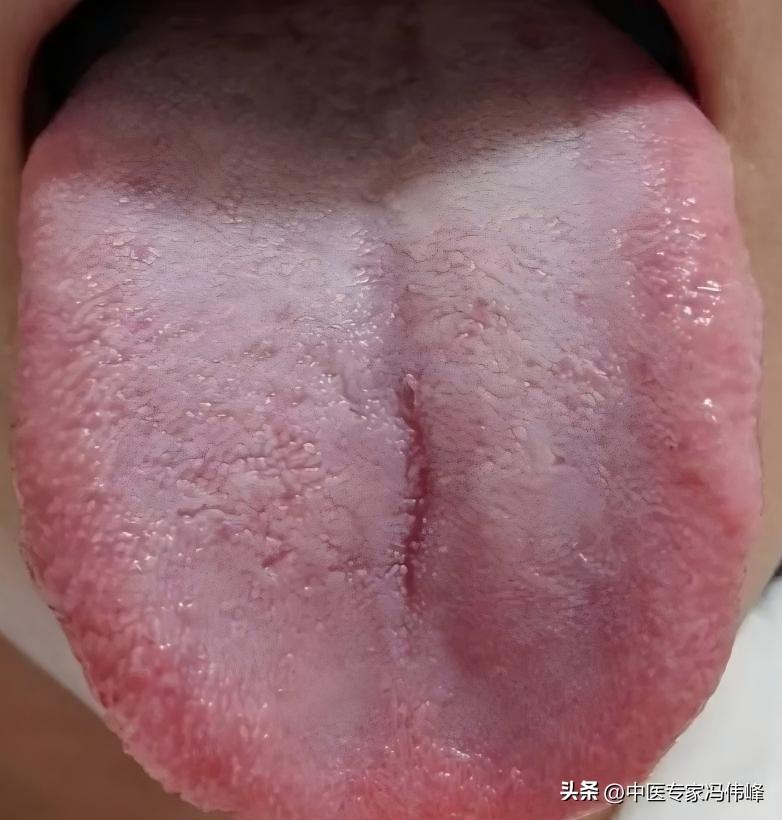 肝气郁结6个阶段的舌象
肝气郁结舌象参考:道遥丸
表现:情绪郁闷，爱生闷气，总感