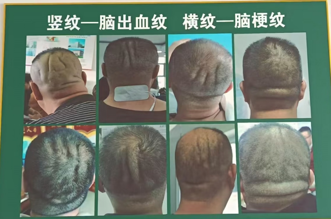 后脑勺头皮，得注意了。 