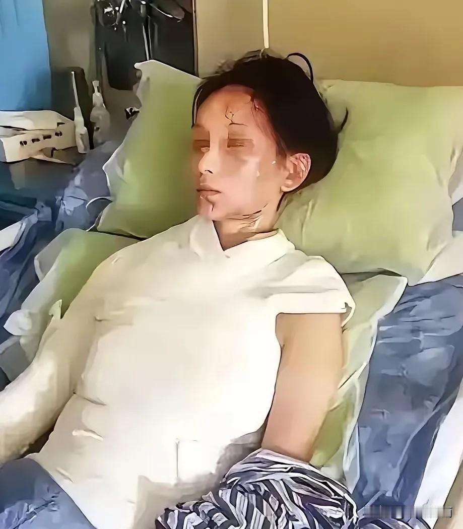悲剧还是发生了！热水器超期用2年，女子洗澡遇爆炸，95%烫伤捡回一条命，厂家无需