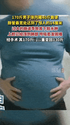 陕西西安，一名男子因为长期便秘，体内积了整整40斤粪便。肠管最宽的地方达14厘米