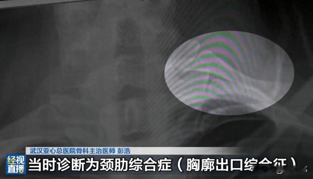 “万万没想到！”9月13日报道，湖北武汉，一女子被颈痛、手麻折磨了一年，每次脖子