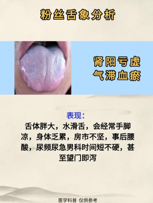 2 例粉丝舌象辨证：肾虚湿热调理法
