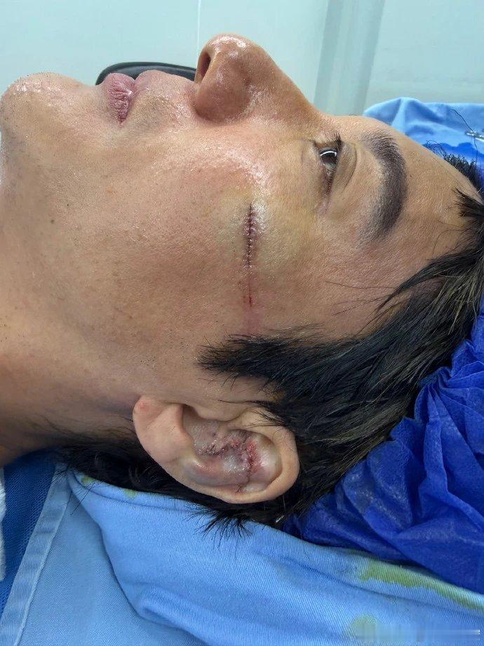 【突发舞台事故，王力宏凌晨回应伤情：缝了39针，外耳软骨撞碎了】7月4日，王力宏