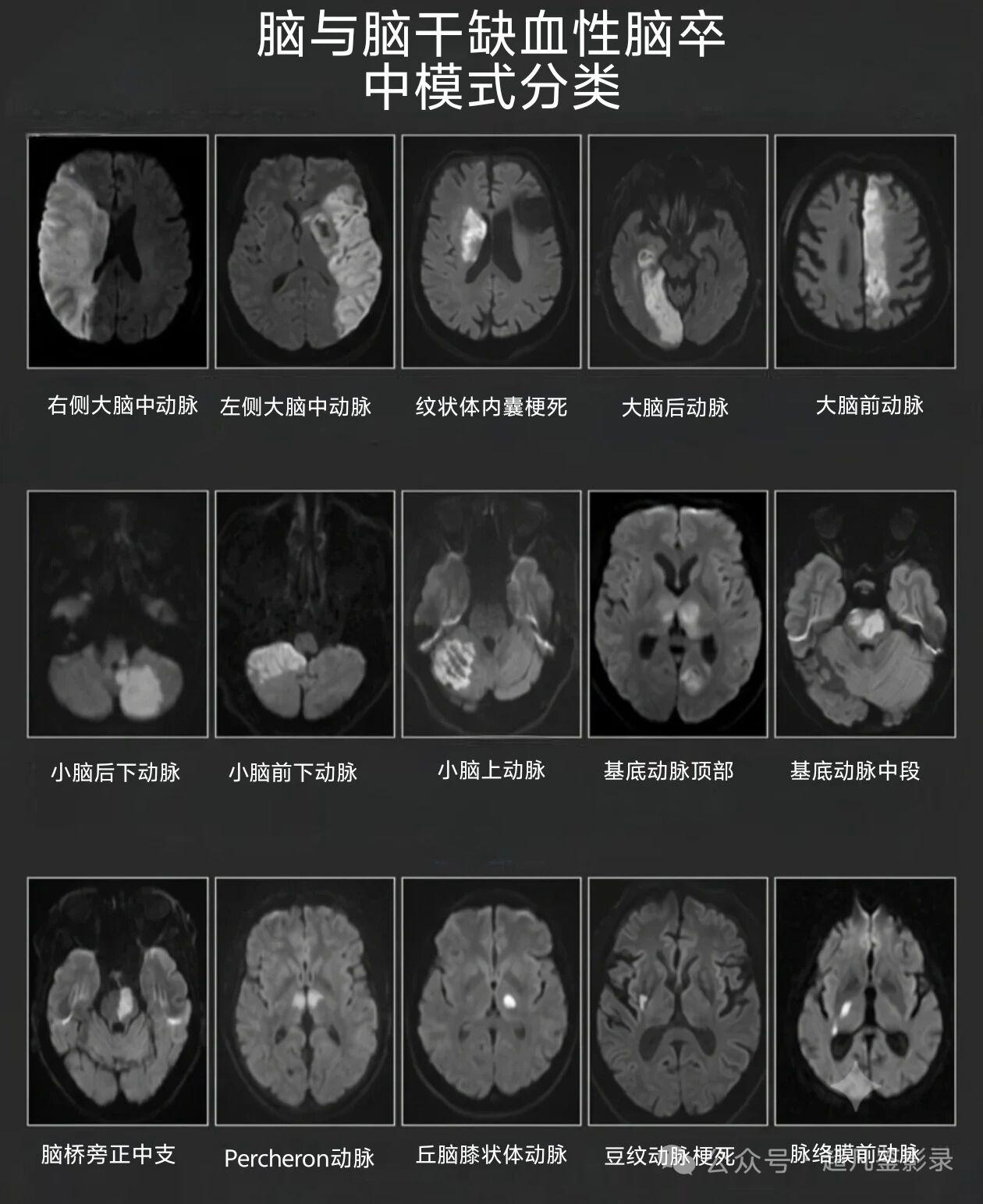 猜猜神经科医生最害怕遇到的梗死血管是哪一条？
半身不遂的大脑中动脉？
全身不遂的