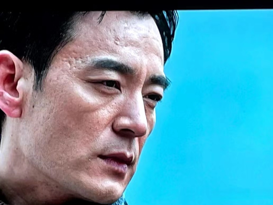 痘坑真的很影响颜值你们知道痘坑对一个人的伤害有多大吗明明很光滑的一张脸上，现在坑