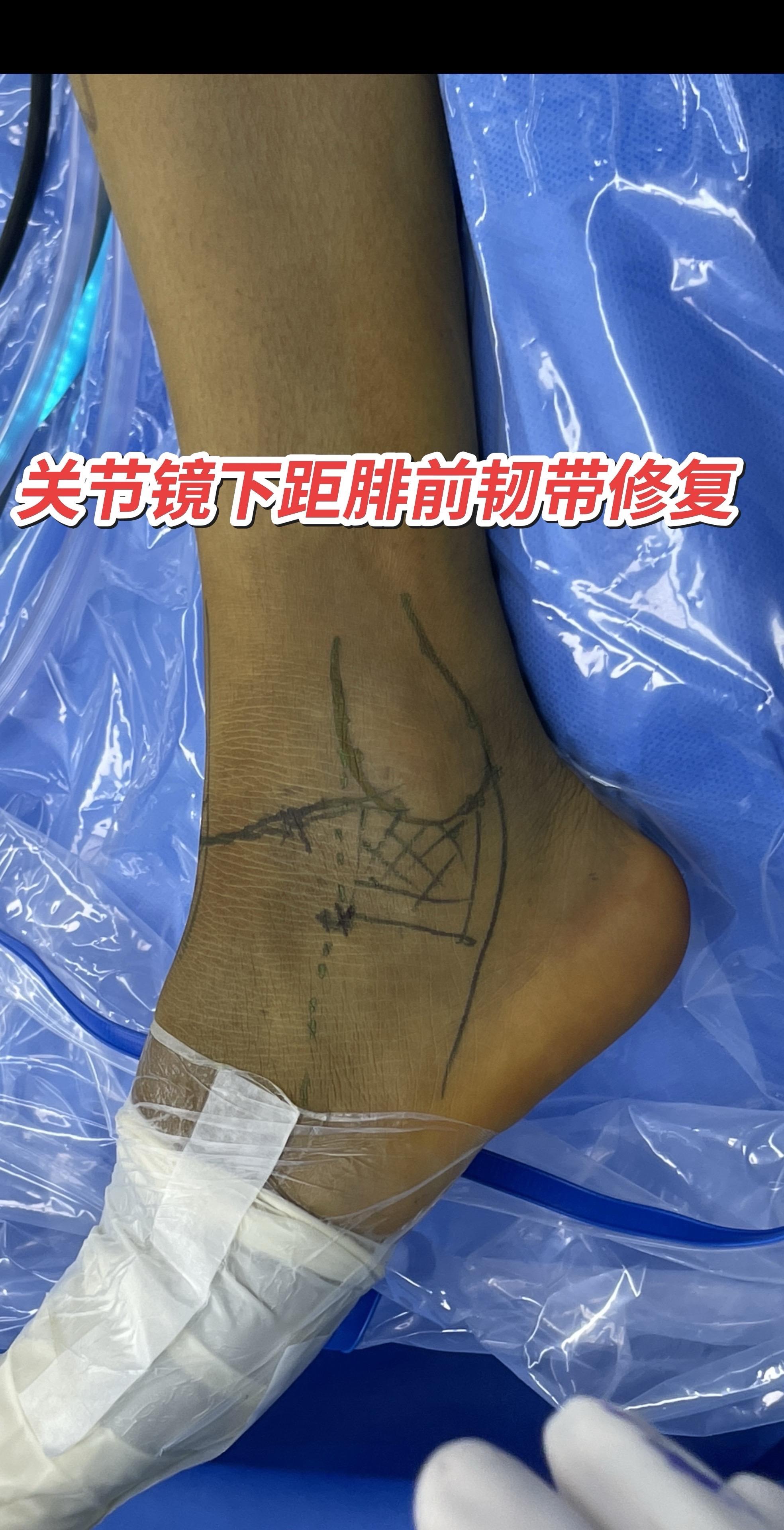 关节镜下距腓前韧带修复术。