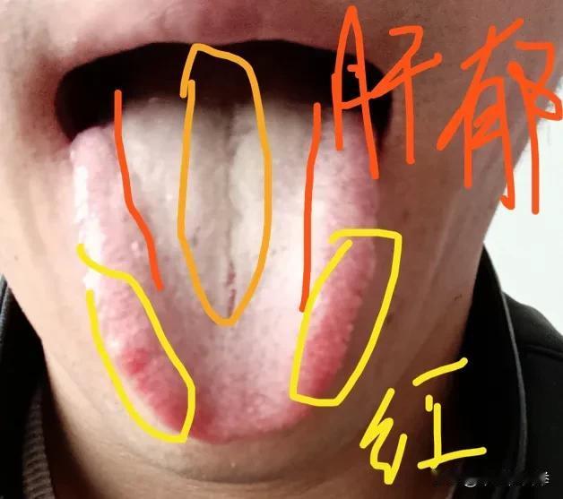 舌诊分享：
肝气化热—舌面肝郁线明显，舌边红的比较明显，对应肝胆，脾气急躁、眼睛