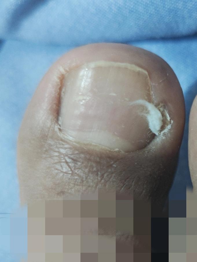 我的甲沟炎康复之路。
最开始患甲沟炎的时候，我是没有在意的。
我以为过几天就会好