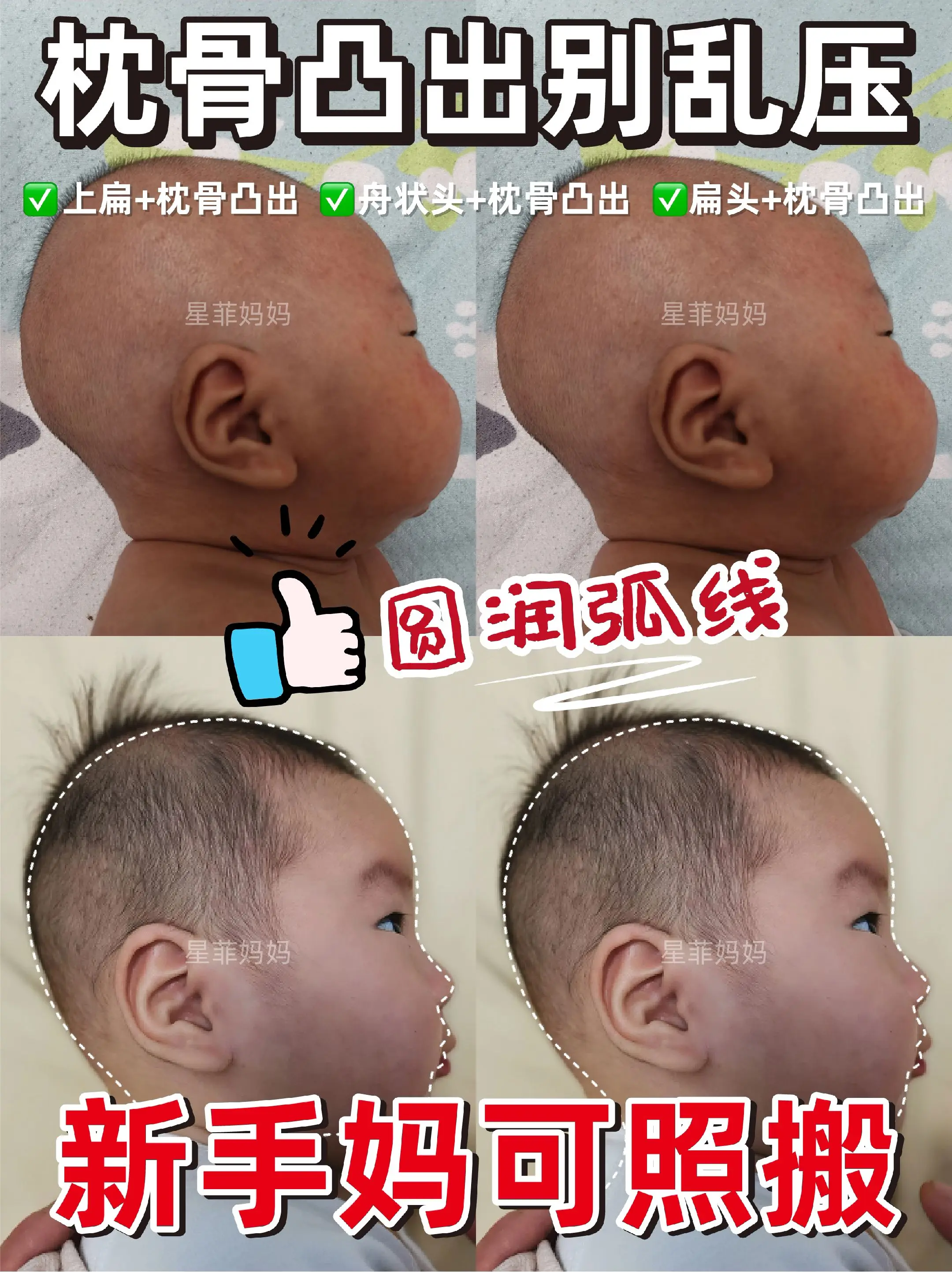 宝宝头型|枕骨凸出别乱压❌小心压成大扁头。