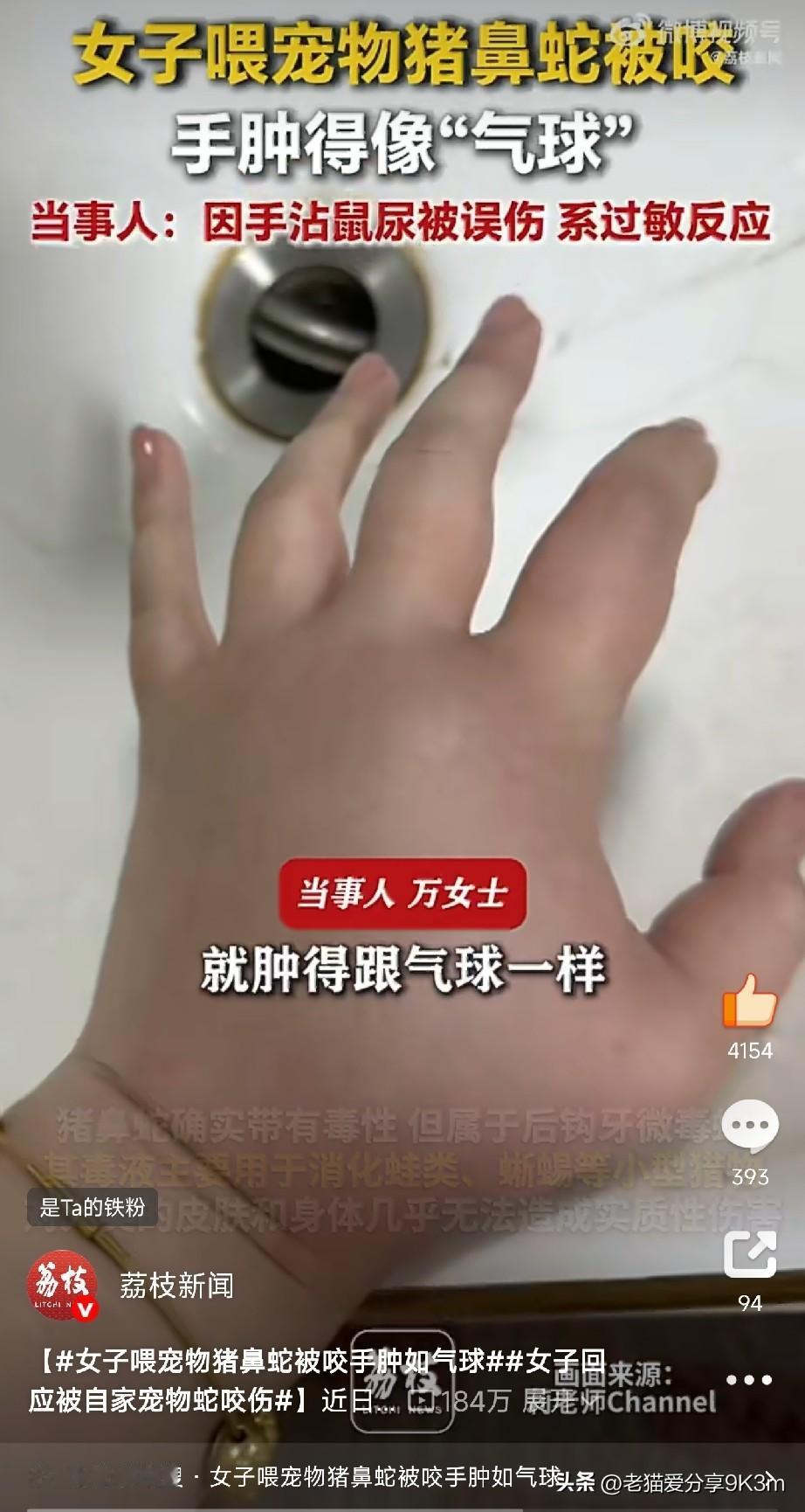 看着都疼！女子被自家宠物蛇咬一口，手肿成“大馒头”

听过养猫养狗的，也听过养仓