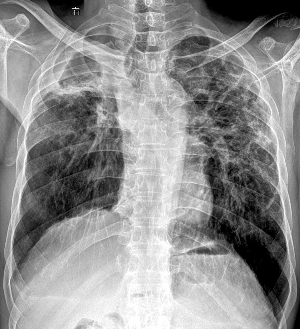 考完了大家考的怎么样 开始继续搬砖吧 男61疫情得过白肺 现在胸闷