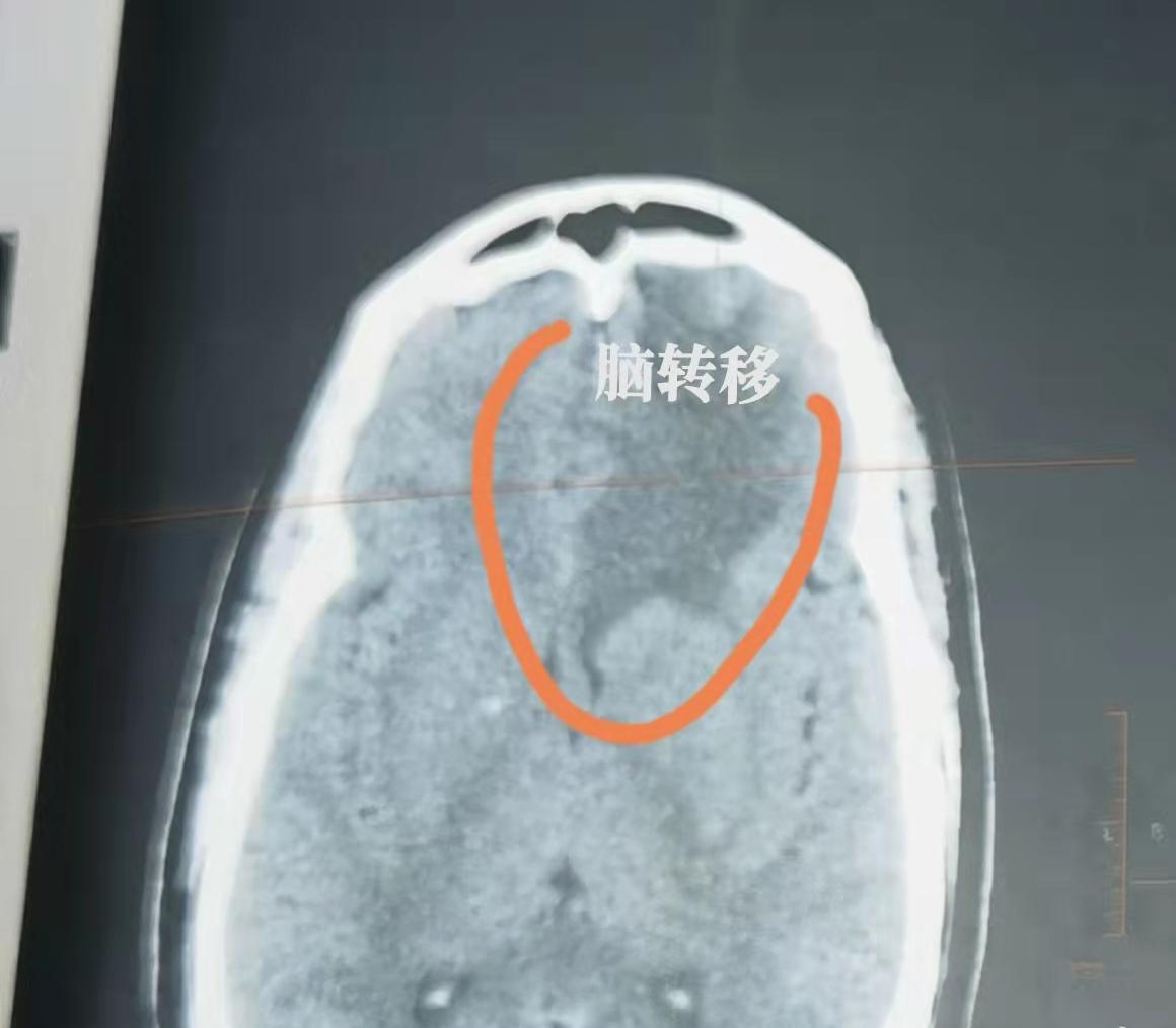 很多朋友都以为，肺癌只要控制住肺部病灶就万事大吉了，其实不然。肺癌最容易发生转移