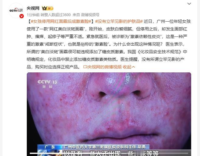 广州年轻女孩使用该面霜期间皮肤白皙细腻，停用十余天后突发面部大面积泛红、灼热、长
