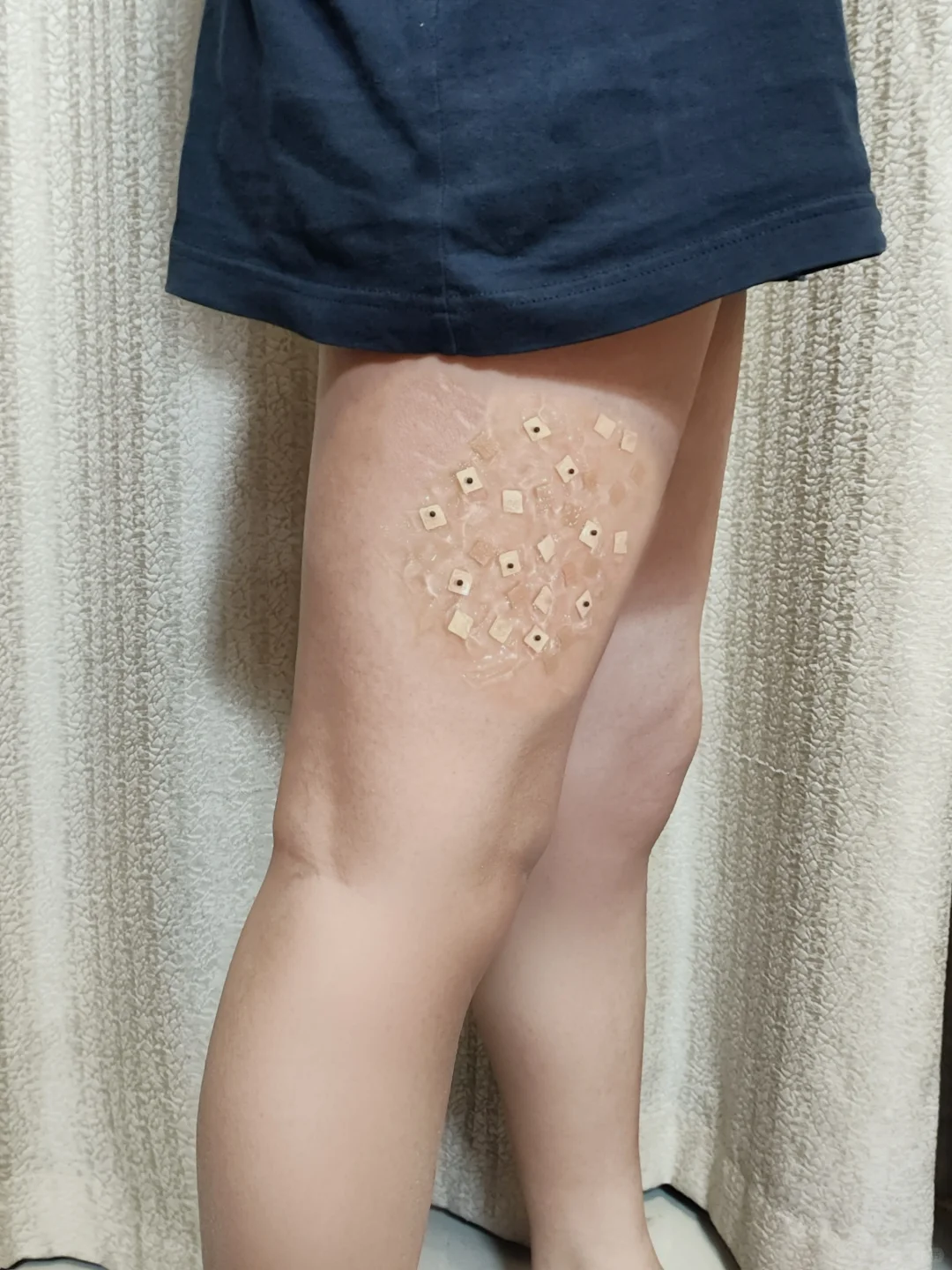 孕期偶然发现！腿上长肥胖纹要小心了！