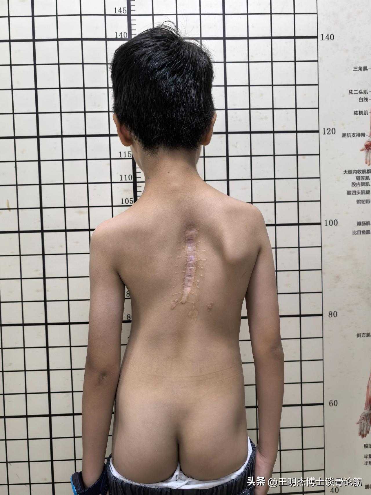 脊柱侧弯已成为危害我国青少年健康的第三大“杀手”


脊柱侧弯不仅会毁掉孩子的体