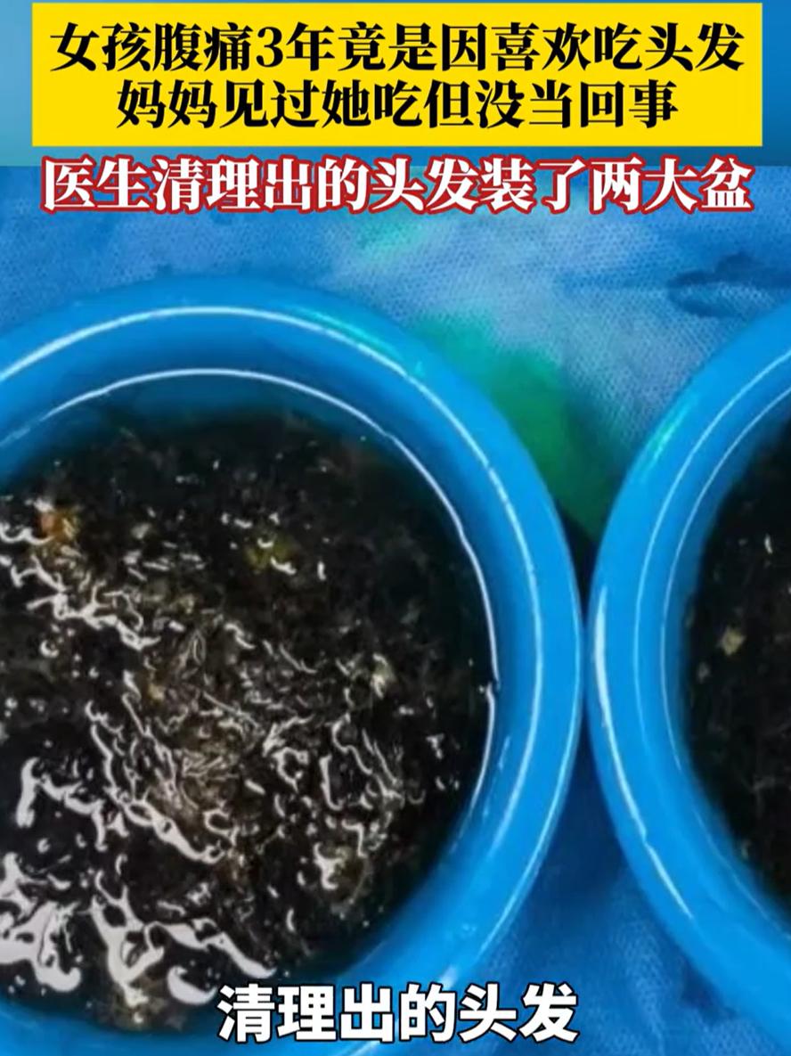 “万万没想到！”福建福州，一名10岁小女孩反复腹痛3年，后来去医院一查，发现胃里