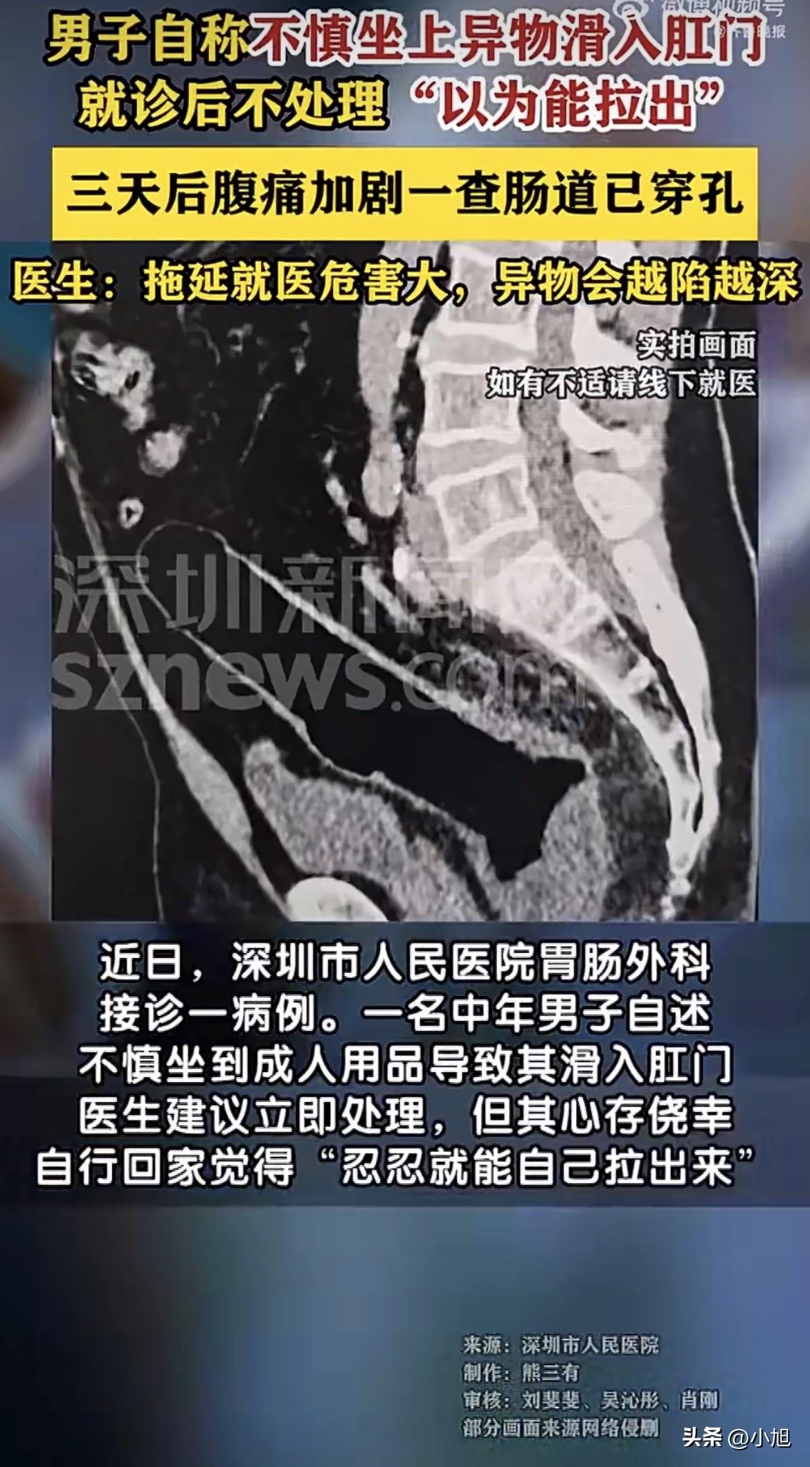 3月初的深圳，一家医院的肛肠科诊室里，一个中年男人捂着肚子，疼得脸色发白。他支支