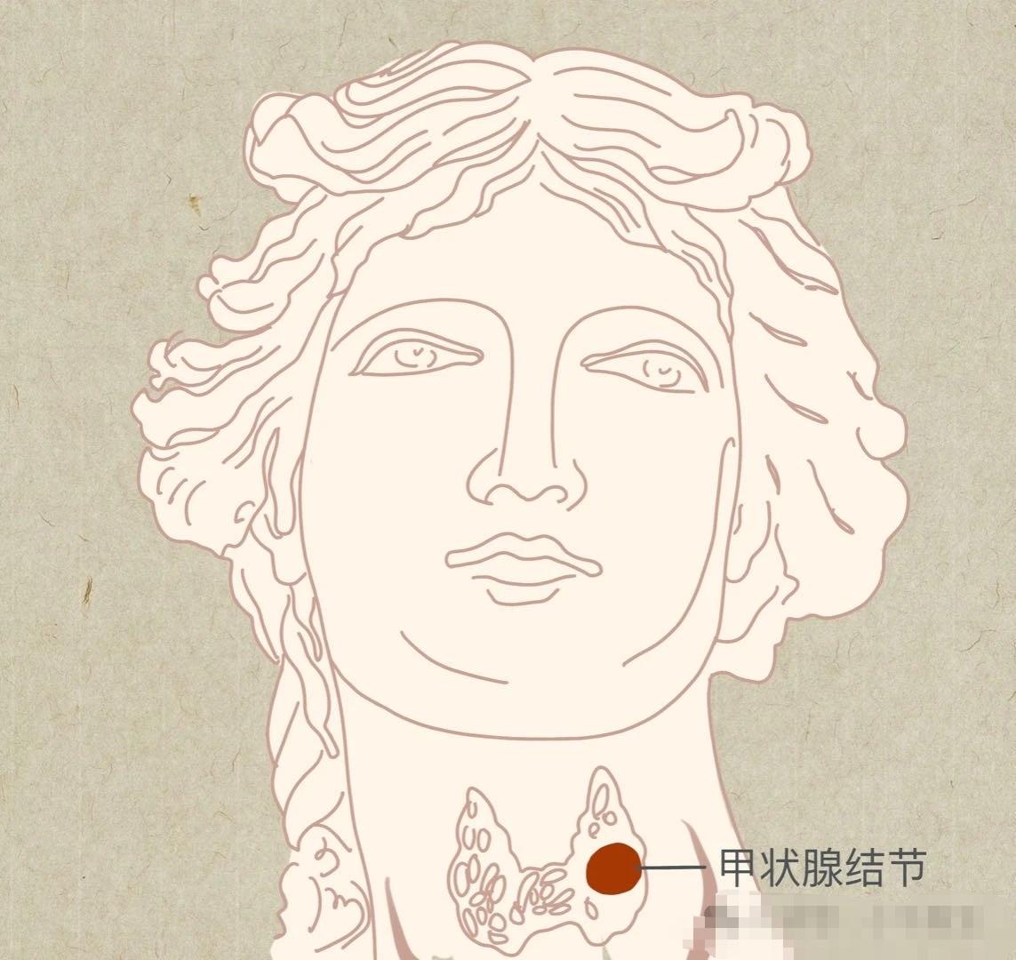 结节=癌？结节产生的原因是多种多样的。除了我们闻之色变的癌症/恶性肿瘤，结节还有可能是正常的组织（如结构紊乱的乳腺腺体组织）、先天发育异常（如支气管囊肿）、细菌病毒真菌等感染引起（如肺结核）、其他炎症（亚急性甲状腺炎），甚至是组织受伤/手术/疾病后的疤痕等等。
对于结节，保持重视并积极寻求专业医生的帮助是对的，但也不用杯弓蛇影、过度焦虑和恐慌。